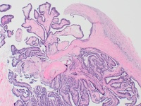 breast-pathology3.jpg